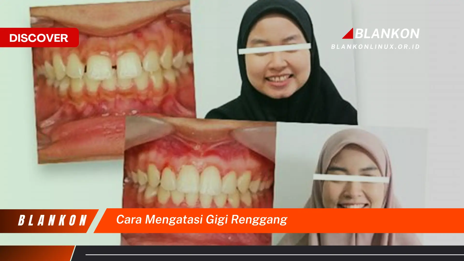 cara mengatasi gigi renggang cara mengatasi gigi renggang