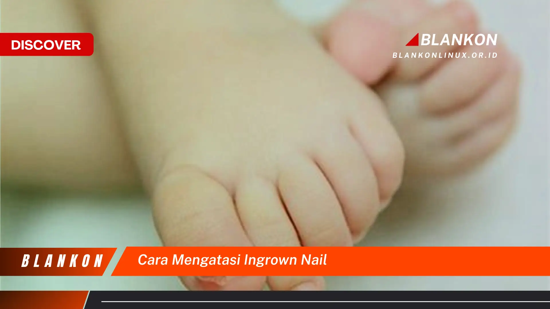 Ketahui Cara Mengatasi Ingrown Nail yang Jarang Diketahui
