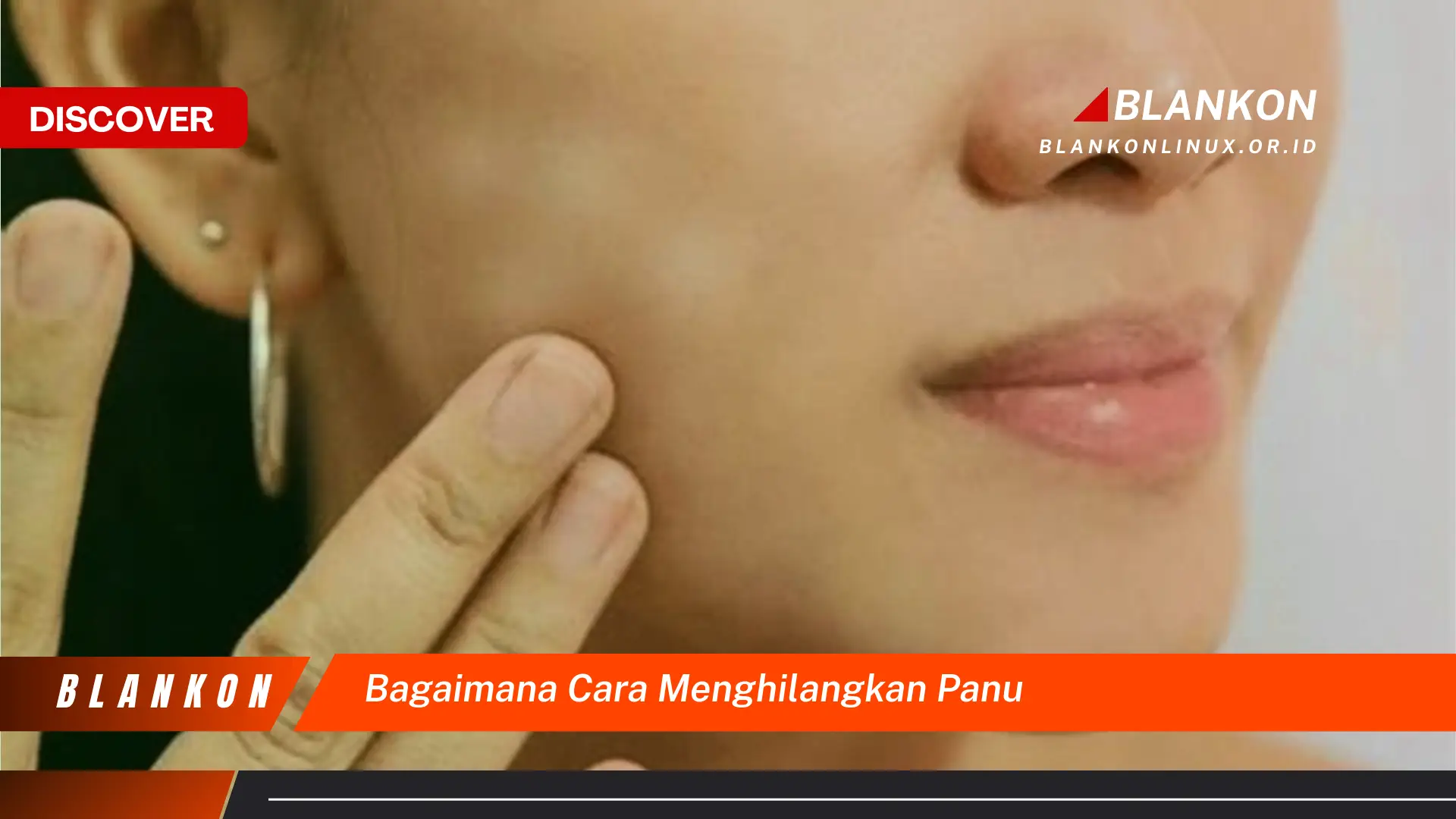 Temukan Cara Menghilangkan Panu yang Jarang Diketahui
