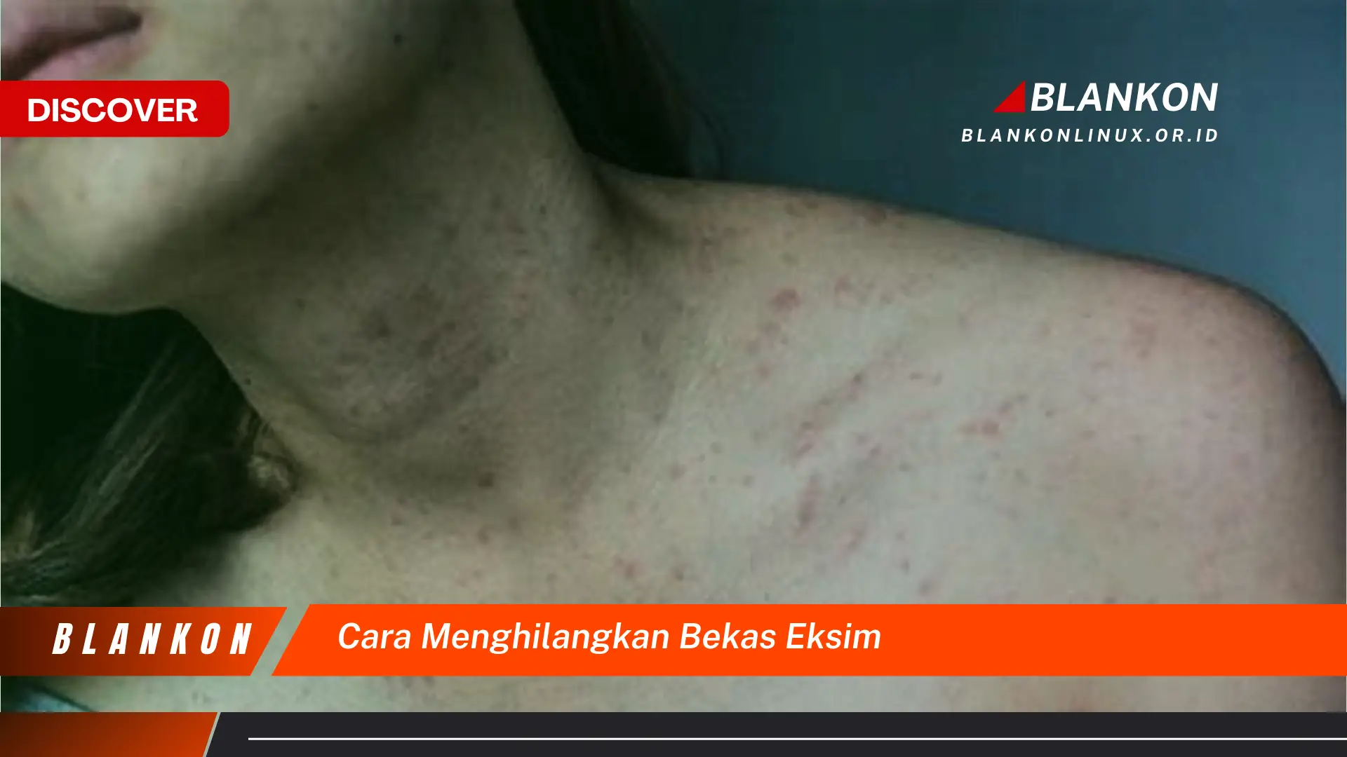 cara menghilangkan bekas eksim