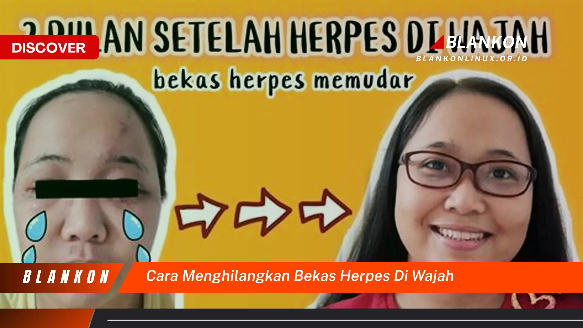 Temukan Cara Menghilangkan Bekas Herpes di Wajah yang Jarang Diketahui