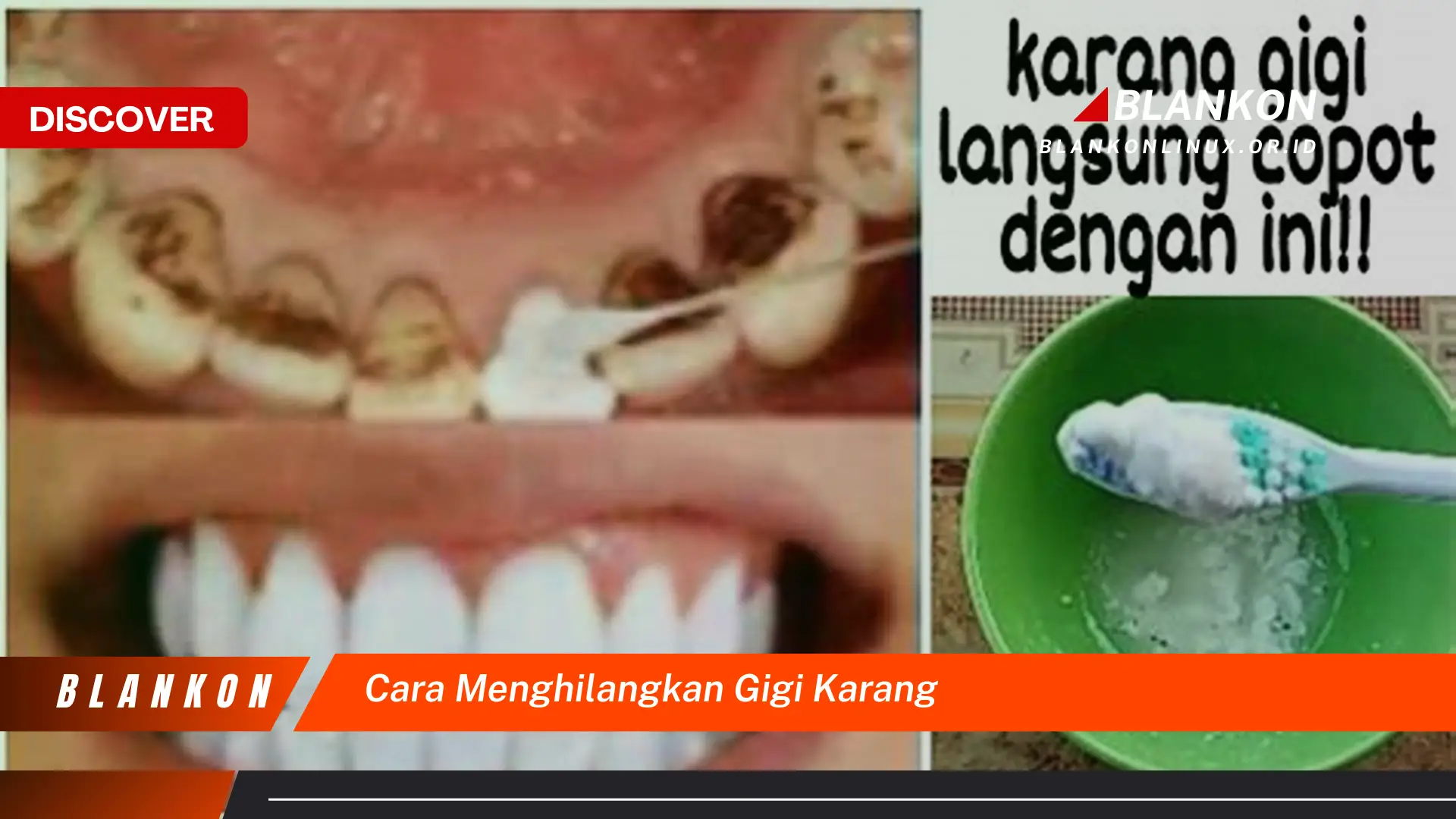 cara menghilangkan gigi karang