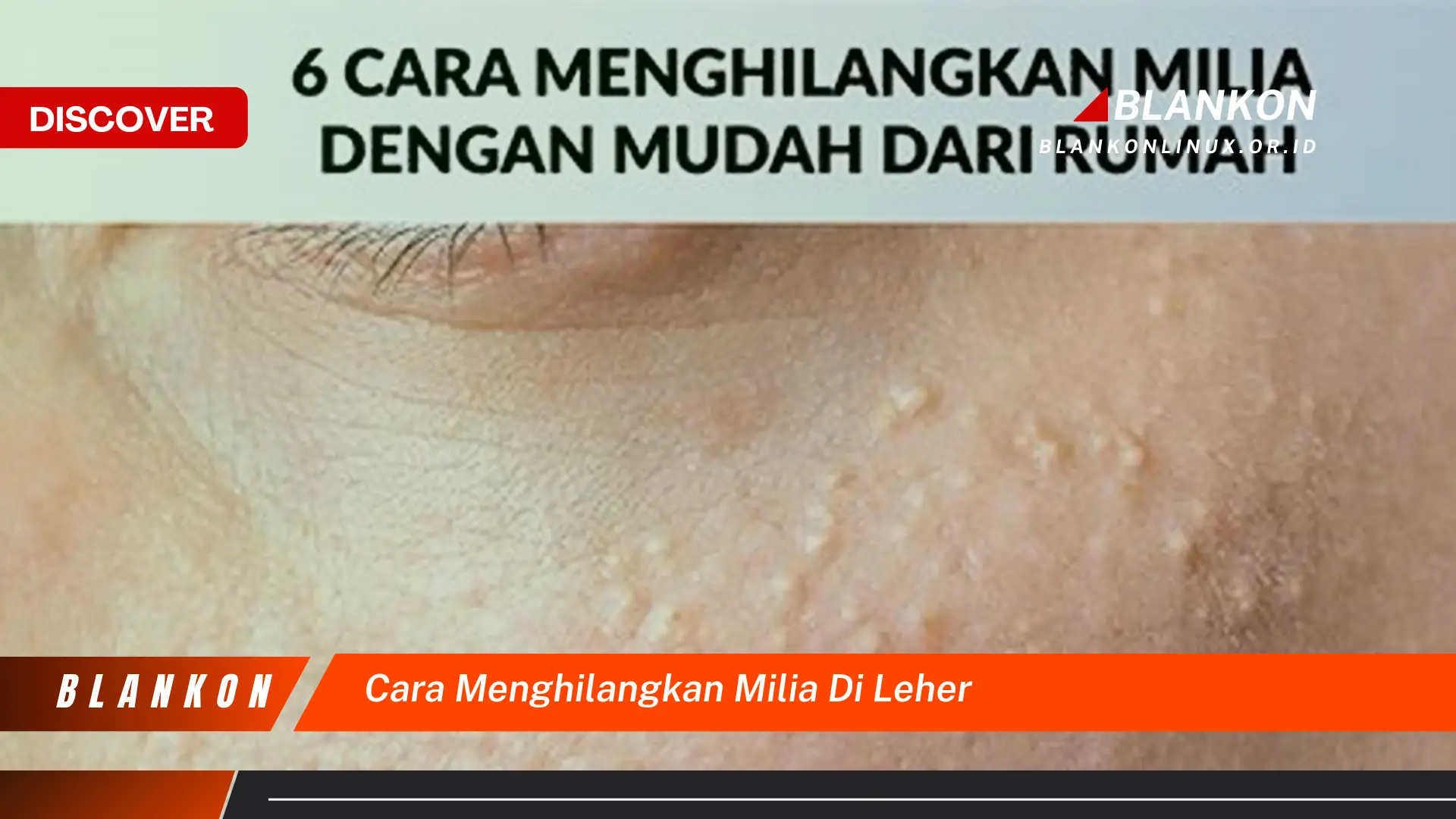 cara menghilangkan milia di leher